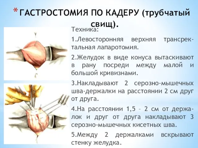 ГАСТРОСТОМИЯ ПО КАДЕРУ (трубчатый свищ). Техника: 1.Левосторонняя верхняя трансрек-тальная лапаротомия. 2.Желудок в