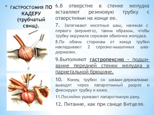 ГАСТРОСТОМИЯ ПО КАДЕРУ (трубчатый свищ). 6.В отверстие в стенке желудка вставляют резиновую