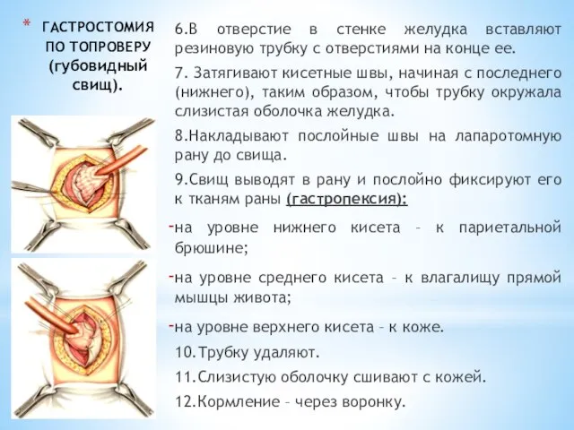 ГАСТРОСТОМИЯ ПО ТОПРОВЕРУ (губовидный свищ). 6.В отверстие в стенке желудка вставляют резиновую