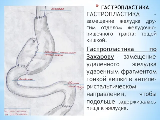 ГАСТРОПЛАСТИКА ГАСТРОПЛАСТИКА –замещение желудка дру-гим отделом желудочно-кишечного тракта: тощей кишкой. Гастропластика по