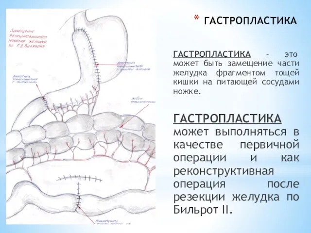 ГАСТРОПЛАСТИКА ГАСТРОПЛАСТИКА – это может быть замещение части желудка фрагментом тощей кишки