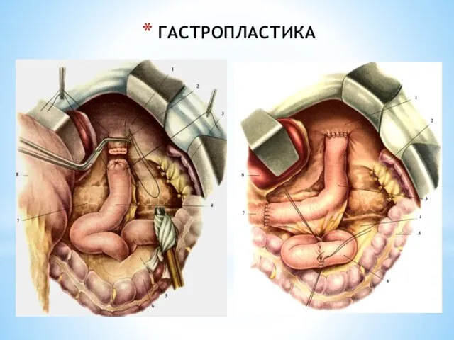 ГАСТРОПЛАСТИКА