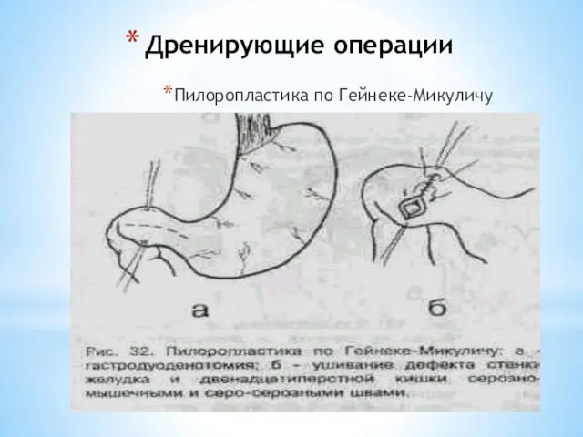 Дренирующие операции Пилоропластика по Гейнеке-Микуличу