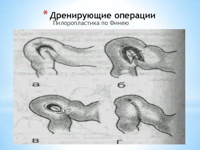 Дренирующие операции Пилоропластика по Финею