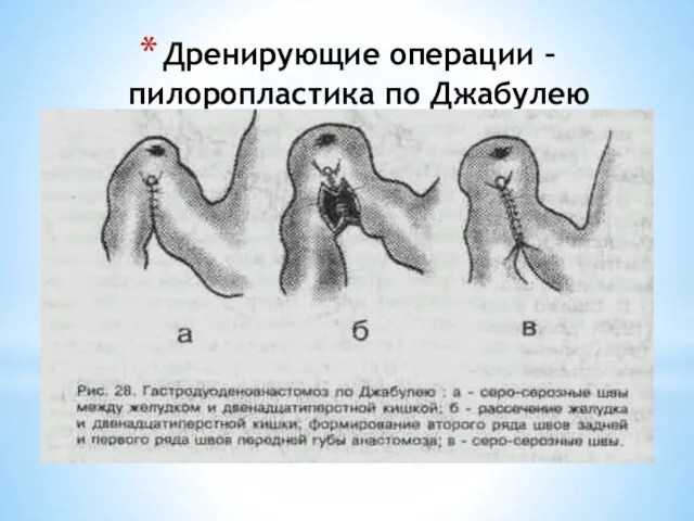 Дренирующие операции –пилоропластика по Джабулею