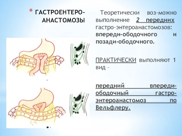 ГАСТРОЕНТЕРО-АНАСТОМОЗЫ Теоретически воз-можно выполнение 2 передних гастро-энтероанастомозов: впереди-ободочного и позади-ободочного. ПРАКТИЧЕСКИ выполняют