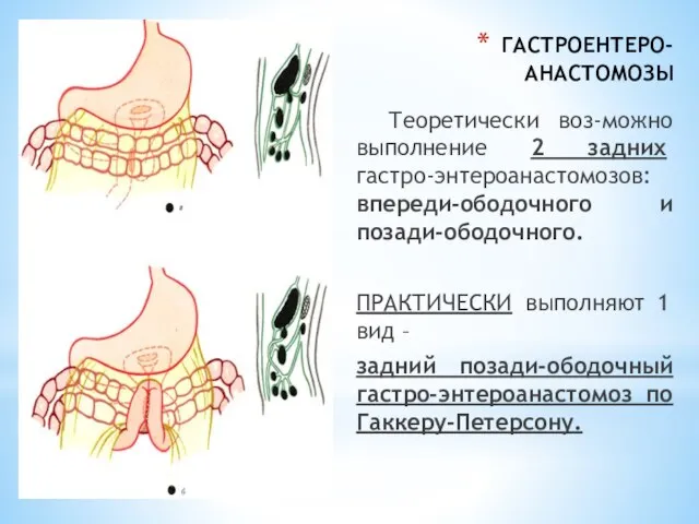 ГАСТРОЕНТЕРО-АНАСТОМОЗЫ Теоретически воз-можно выполнение 2 задних гастро-энтероанастомозов: впереди-ободочного и позади-ободочного. ПРАКТИЧЕСКИ выполняют