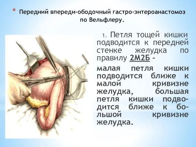 Передний впереди-ободочный гастро-энтероанастомоз по Вельфлеру. 1. Петля тощей кишки подводится к передней