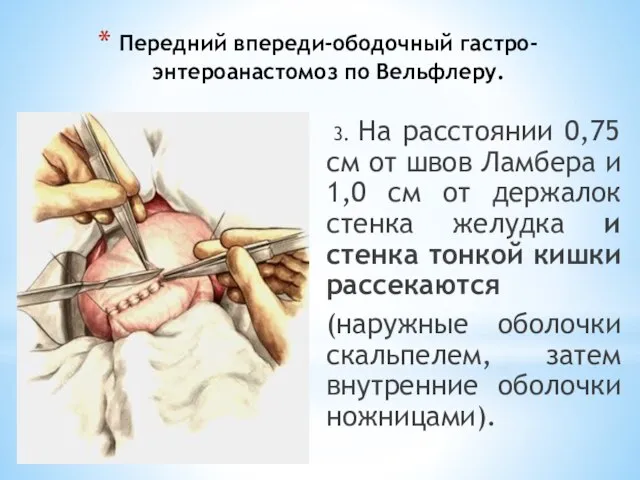 Передний впереди-ободочный гастро-энтероанастомоз по Вельфлеру. 3. На расстоянии 0,75 см от швов