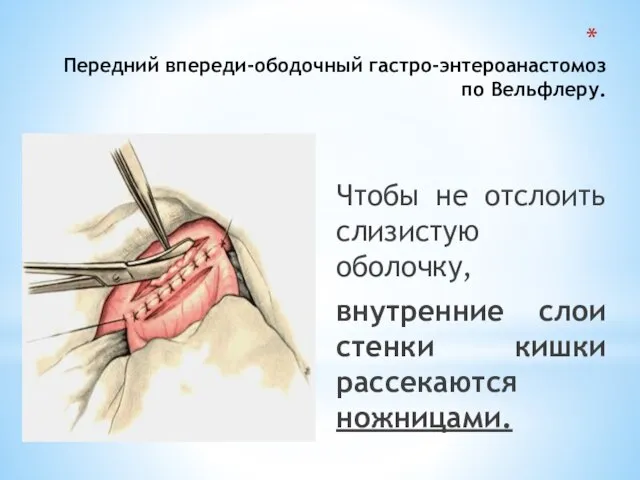 Передний впереди-ободочный гастро-энтероанастомоз по Вельфлеру. Чтобы не отслоить слизистую оболочку, внутренние слои стенки кишки рассекаются ножницами.