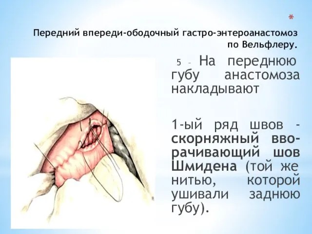 Передний впереди-ободочный гастро-энтероанастомоз по Вельфлеру. 5 – На переднюю губу анастомоза накладывают