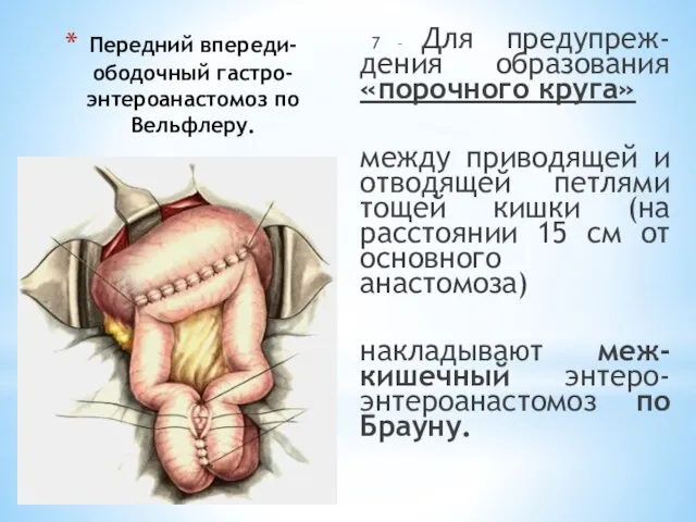 Передний впереди-ободочный гастро-энтероанастомоз по Вельфлеру. 7 – Для предупреж-дения образования «порочного круга»