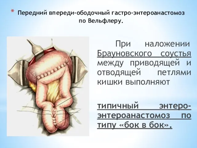 Передний впереди-ободочный гастро-энтероанастомоз по Вельфлеру. При наложении Брауновского соустья между приводящей и