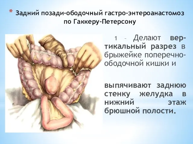 Задний позади-ободочный гастро-энтероанастомоз по Гаккеру-Петерсону 1 – Делают вер-тикальный разрез в брыжейке