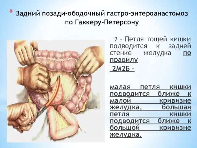 Задний позади-ободочный гастро-энтероанастомоз по Гаккеру-Петерсону 2 - Петля тощей кишки подводится к