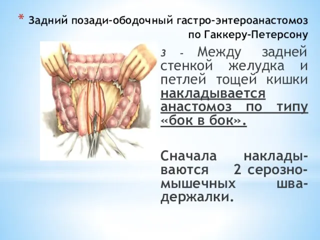 Задний позади-ободочный гастро-энтероанастомоз по Гаккеру-Петерсону 3 – Между задней стенкой желудка и