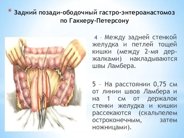 Задний позади-ободочный гастро-энтероанастомоз по Гаккеру-Петерсону 4 – Между задней стенкой желудка и