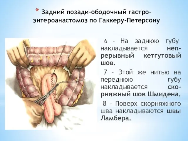 Задний позади-ободочный гастро-энтероанастомоз по Гаккеру-Петерсону 6 – На заднюю губу накладывается неп-рерывный