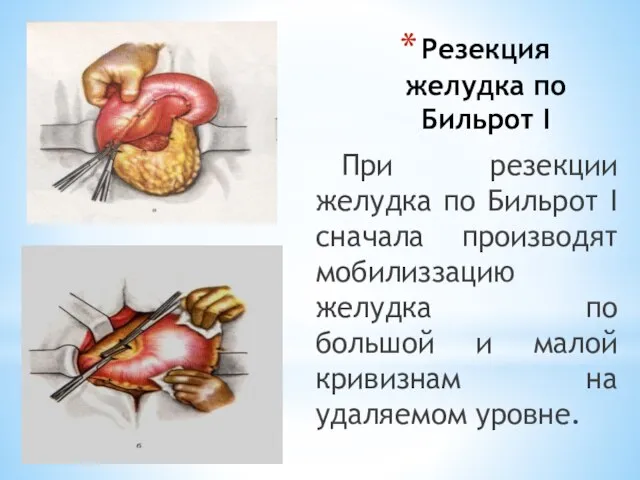 Резекция желудка по Бильрот I При резекции желудка по Бильрот I сначала