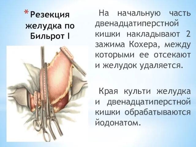 Резекция желудка по Бильрот I На начальную часть двенадцатиперстной кишки накладывают 2