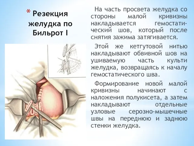 Резекция желудка по Бильрот I На часть просвета желудка со стороны малой