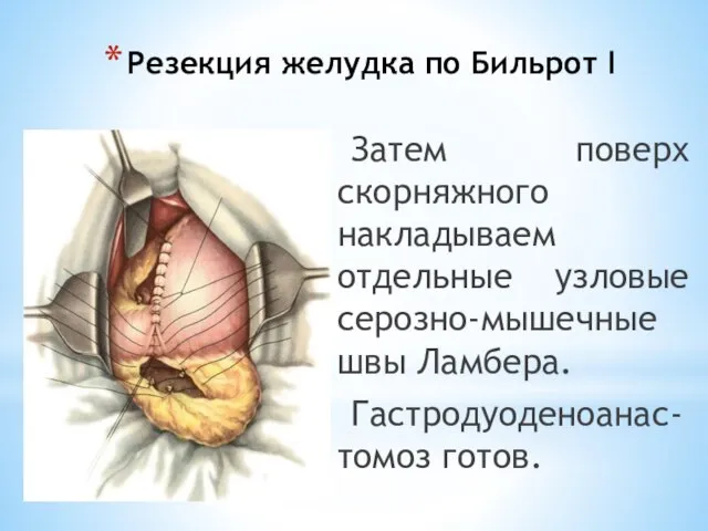 Резекция желудка по Бильрот I Затем поверх скорняжного накладываем отдельные узловые серозно-мышечные швы Ламбера. Гастродуоденоанас-томоз готов.