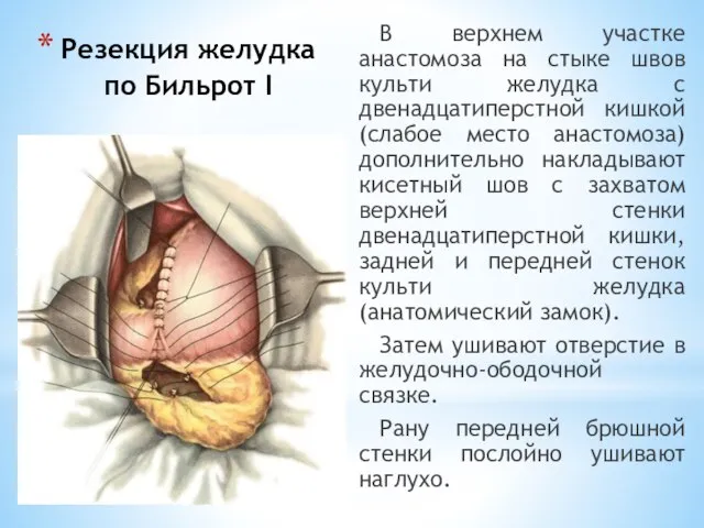 Резекция желудка по Бильрот I В верхнем участке анастомоза на стыке швов