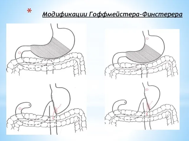 Модификации Гоффмейстера-Финстерера