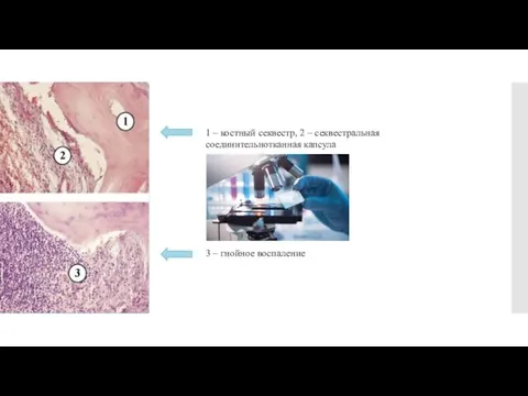 1 – костный секвестр, 2 – секвестральная соединительнотканная капсула 3 – гнойное воспаление