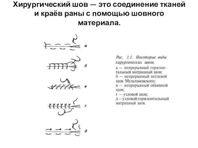 Хирургический шов — это соединение тканей и краёв раны с помощью шовного материала.