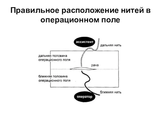 Правильное расположение нитей в операционном поле