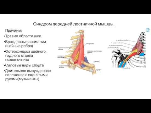 Синдром передней лестничной мышцы. Причины: Травма области шеи Врожденные аномалии(шейные ребра) Остеохондроз