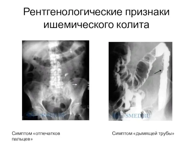 Рентгенологические признаки ишемического колита Симптом «отпечатков пальцев» Симптом «дымящей трубы»
