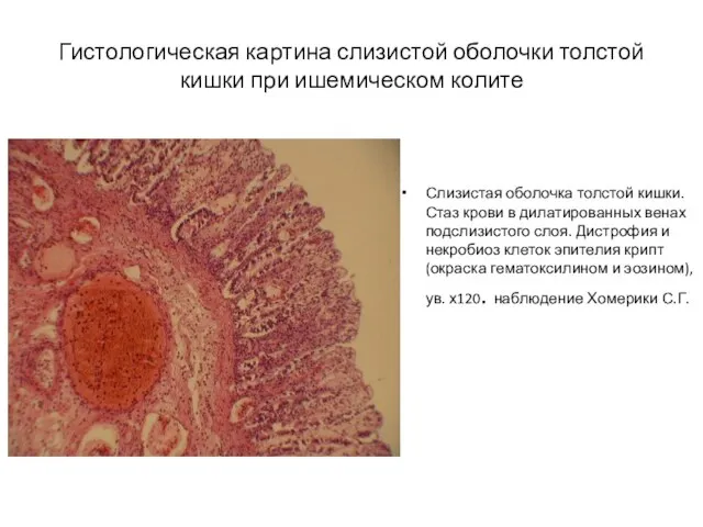 Гистологическая картина слизистой оболочки толстой кишки при ишемическом колите Слизистая оболочка толстой