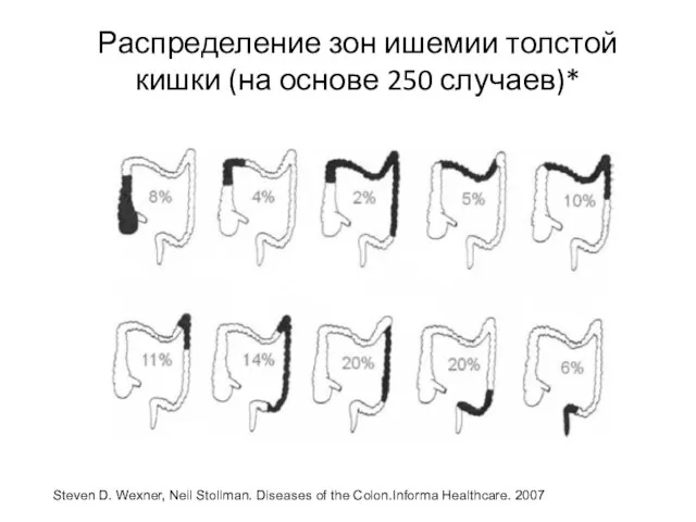 Распределение зон ишемии толстой кишки (на основе 250 случаев)* Steven D. Wexner,