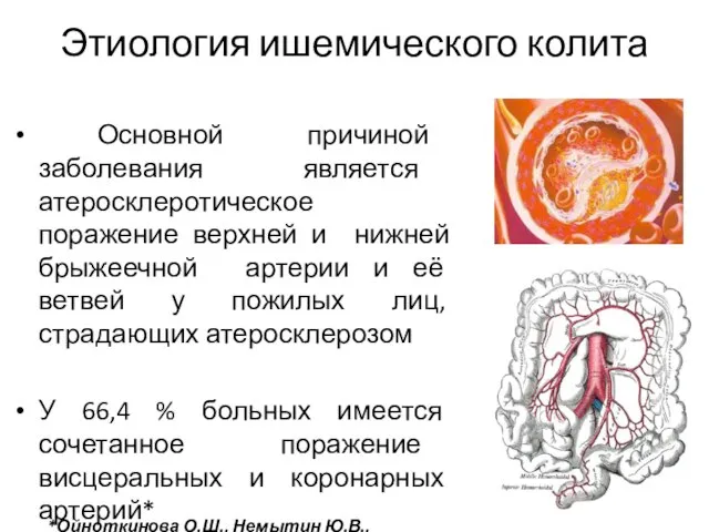 Этиология ишемического колита Основной причиной заболевания является атеросклеротическое поражение верхней и нижней