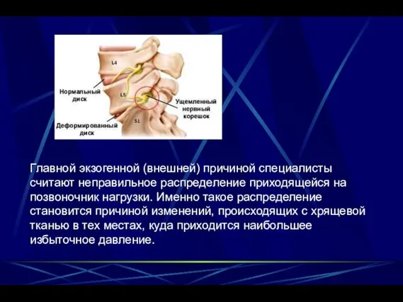 Главной экзогенной (внешней) причиной специалисты считают неправильное распределение приходящейся на позвоночник нагрузки.