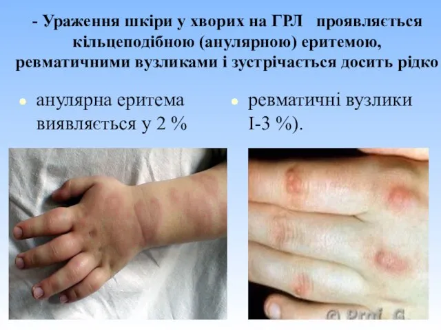 - Ураження шкіри у хворих на ГРЛ проявляється кільцеподібною (анулярною) еритемою, ревматичними