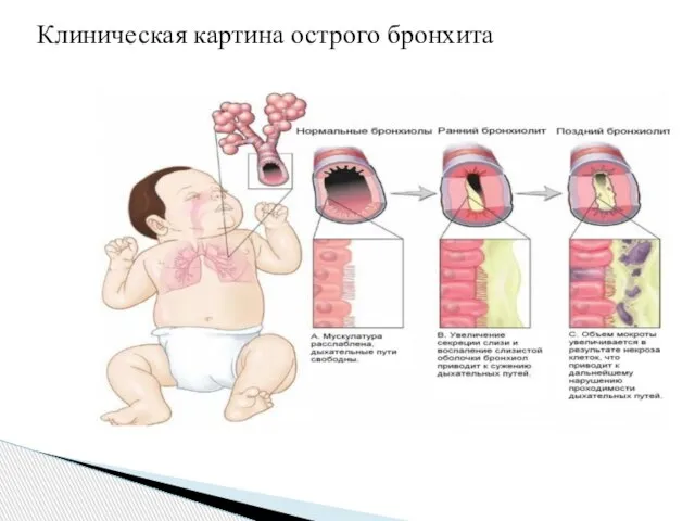 Клиническая картина острого бронхита