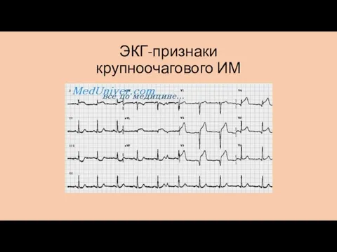 ЭКГ-признаки крупноочагового ИМ