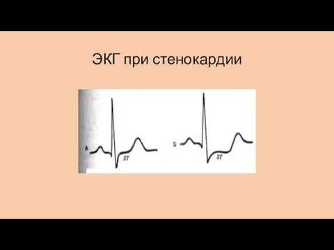 ЭКГ при стенокардии