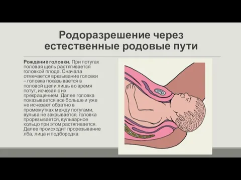Родоразрешение через естественные родовые пути Рождение головки. При потугах половая щель растягивается