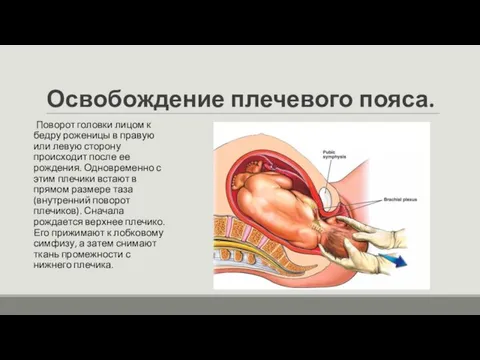 Освобождение плечевого пояса. Поворот головки лицом к бедру роженицы в правую или