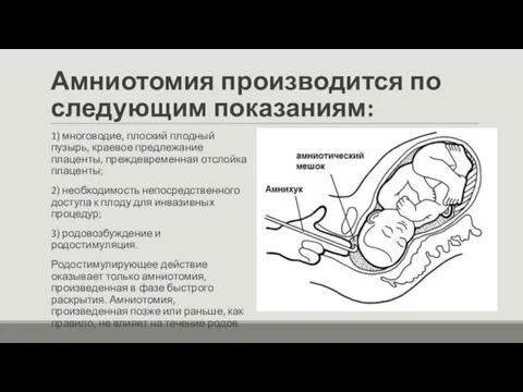 Амниотомия производится по следующим показаниям: 1) многоводие, плоский плодный пузырь, краевое предлежание