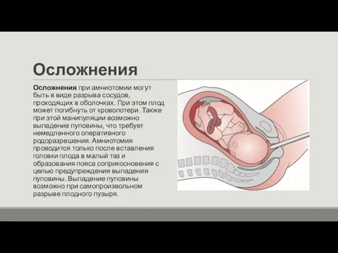 Осложнения Осложнения при амниотомии могут быть в виде разрыва сосудов, проходящих в