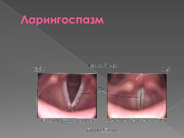 Ларингоспазм