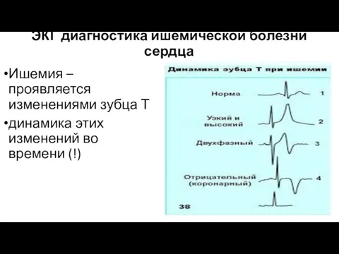 ЭКГ диагностика ишемической болезни сердца Ишемия – проявляется изменениями зубца Т динамика