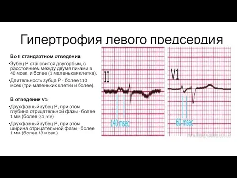 Гипертрофия левого предсердия Во II стандартном отведении: Зубец Р становится двугорбым, с