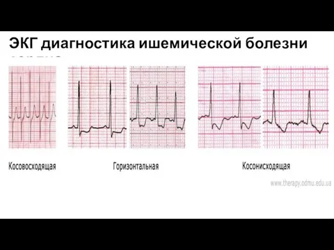 ЭКГ диагностика ишемической болезни сердца