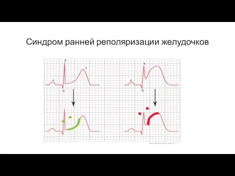 Синдром ранней реполяризации желудочков